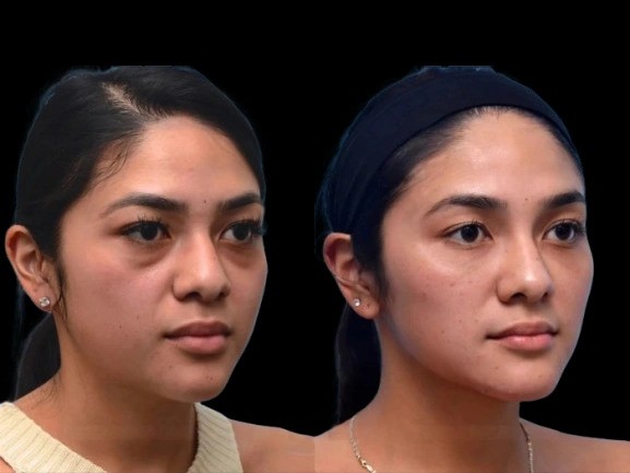 How the Best Doctors in Dubai Treat Persistent Dark Circles