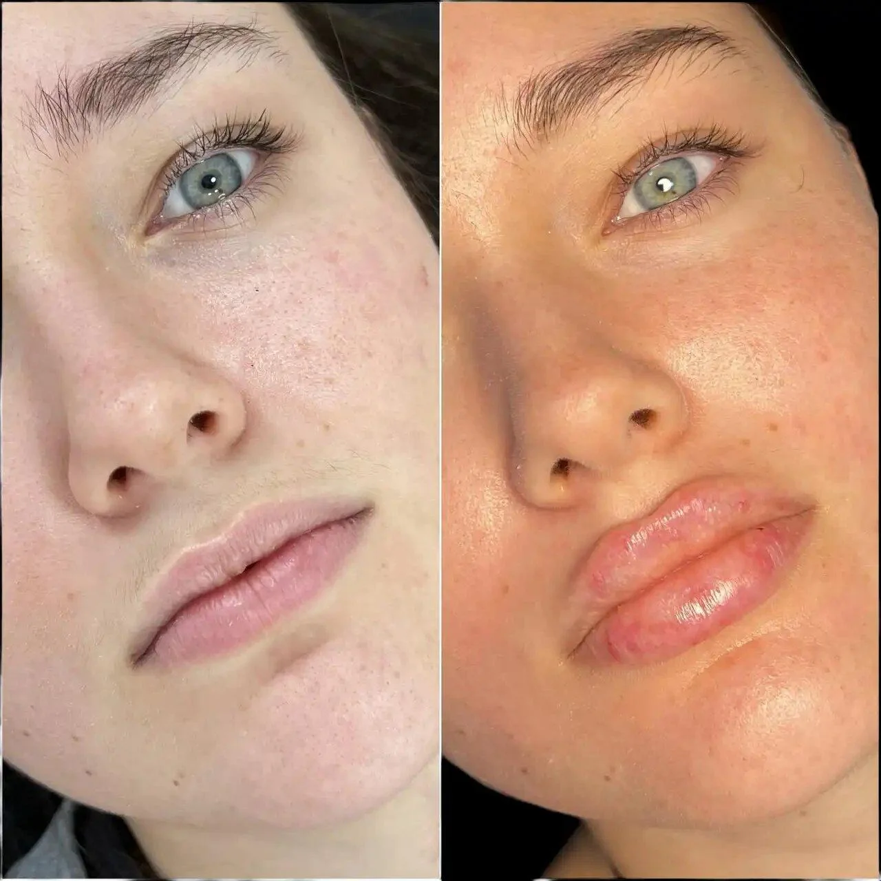 Best Doctors in dubai for Fillers: How They Restore Volume and Youth