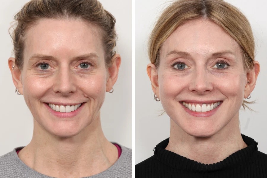 Best Doctors in dubai for Thread Lift Facial Contouring Care