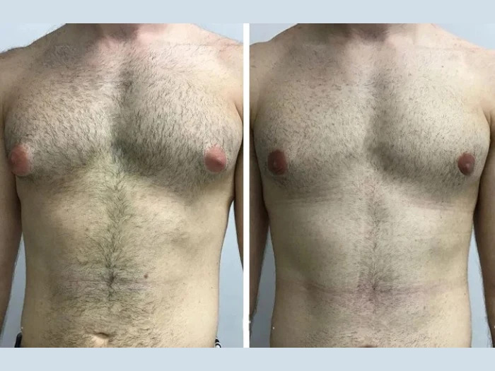 Before & After by the Best Gynecomastia Surgeons in dubai