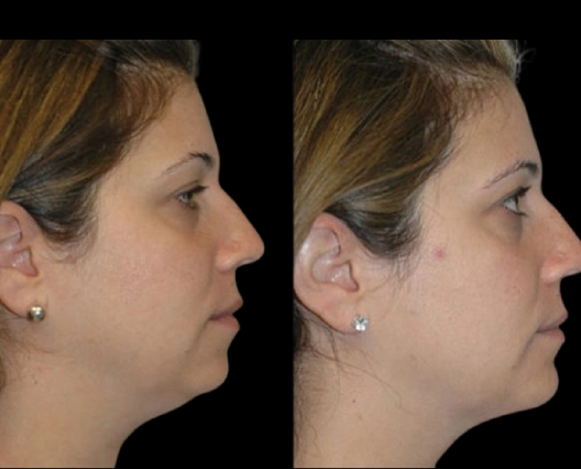 Kybella Treatment Guide by the Best Double Chin Removal Surgeons in Dubai
