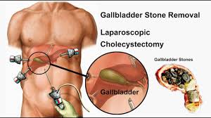 laparoscopic gall bladder stone surgery 
