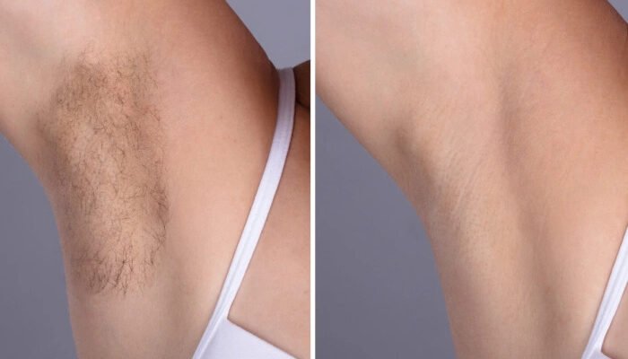 Best Doctors in dubai Suggest the Best Laser Hair Removal Packages for Brides